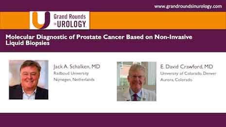 Molecular Diagnostic of Prostate Cancer Based on Non Invasive Liquid Biopsies